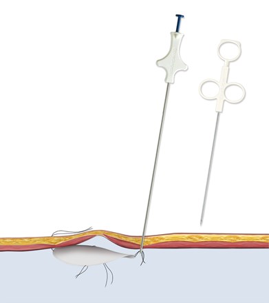 Carter-Thomason® Suture Passer 1