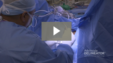 Advincula Delineator Uterine Manipulator – Use in Surgery – Testimonials