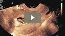 Sono HSG Procedure using ABBI: Air Bubbles Flow in Uterus