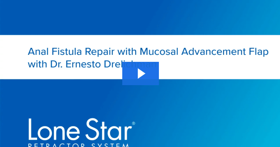 Anal Fistula Repair with Mucosal Advancement Flap Using Lone Star