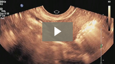 Sono HSG Procedure using ABBI: Fallopian Tube Patency