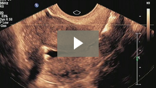 SIS Procedure using ABBI