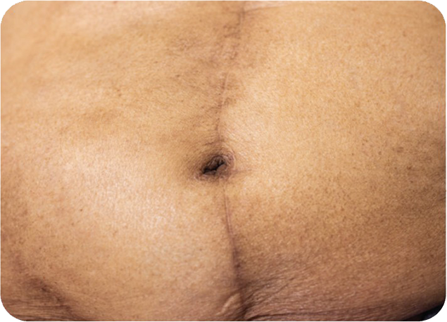 Cosmetic-result-of-INSORB-midline