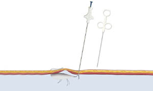 carter-thomason-suture-passer-FI