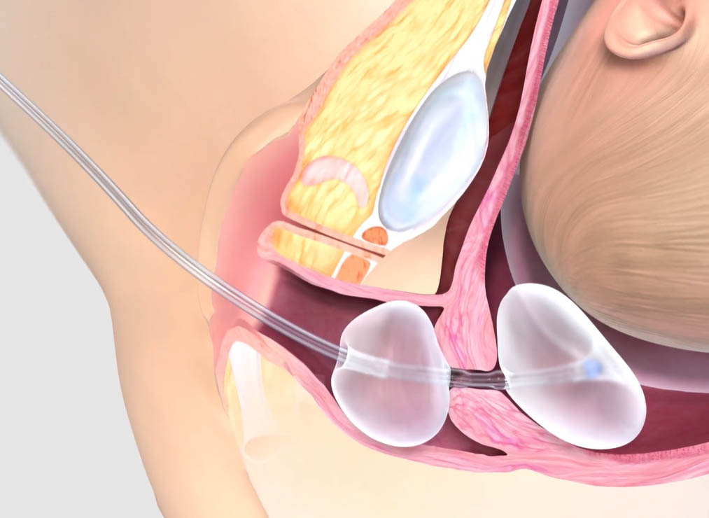 Baby-with-duoRipe-in-action