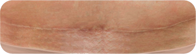 Cosmetic-result-of-INSORB-abdominoplasty