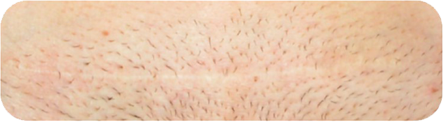 Cosmetic-result-of-INSORB-csection