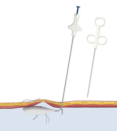 Carter-Thomason Suture Passer piercing the skin and pulling sutures