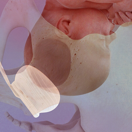Fetal Pillow cushioning baby's head during birthing process