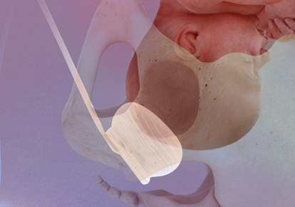 Fetal Pillow cushioning baby's head during birthing process